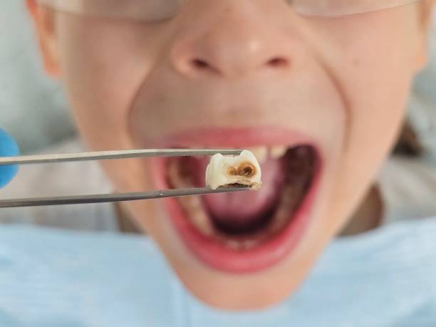 Best Emergency Tooth Extraction in Centrevle, IL